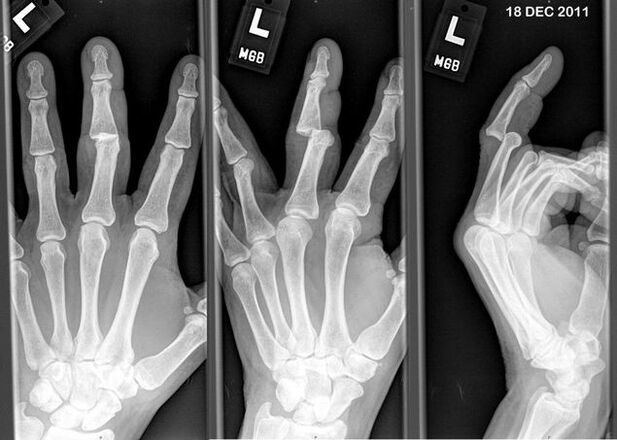 X-ray of displaced fingers