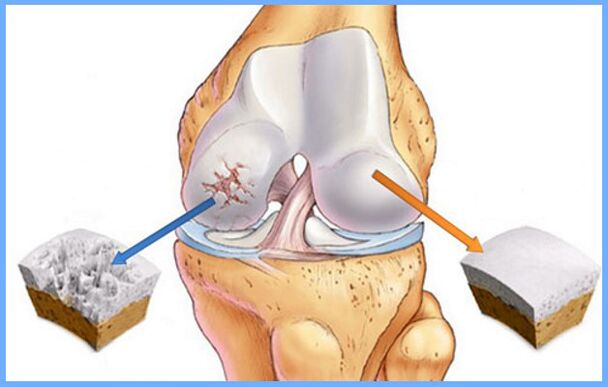 Normal knee joint and arthrosis