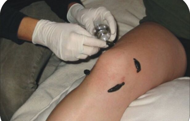 Placement of leeches on the sore knee joint