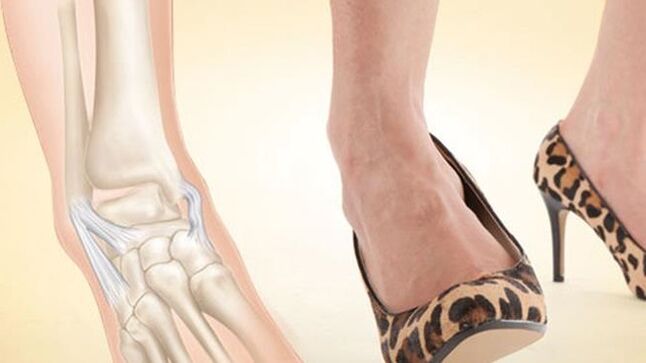 wearing heels as a cause of ankle arthrosis