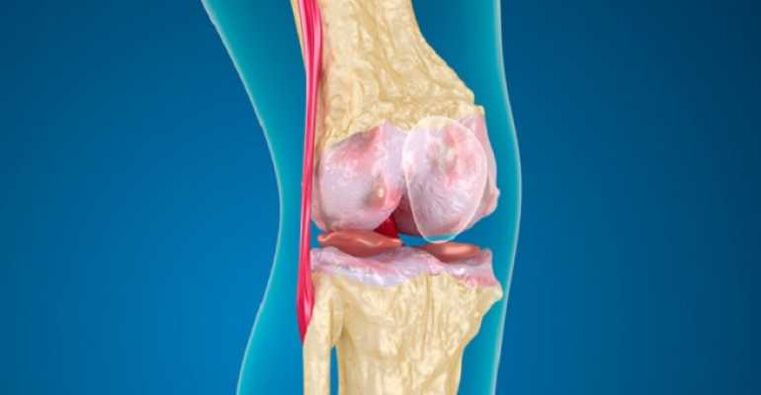 The knee joint disease is a joint that causes the cartilage to be destroyed in the joints