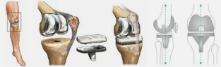 Endoprosthesis for the knee for example