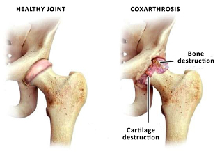 a comparison of a healthy joint, and the hip sustave